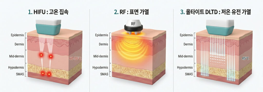 Apaguard AllTight DLTD 技术与传统 HIFU 和射频提拉的能量传输方式比较信息图