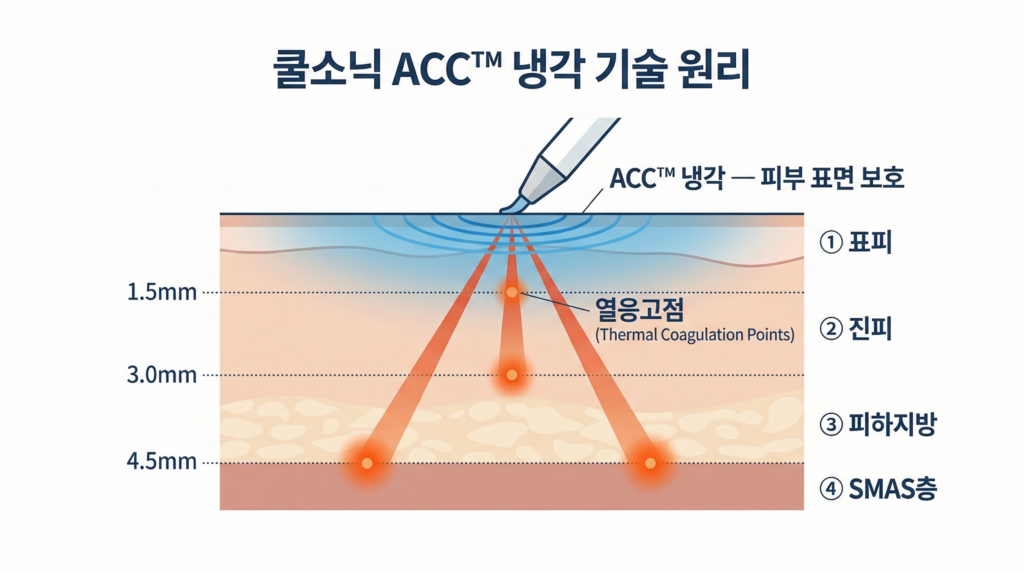 Thumbtack CoolSonic ACC 冷却技术原理 皮肤横截面 SMAS 层超声波能量传递示意图