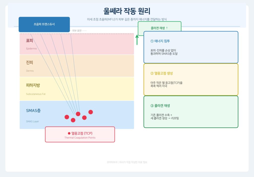 了解 Ulthera 副作用的原理--在表皮-真皮-SMAS 层形成热凝点 (TCP) 的过程信息图表