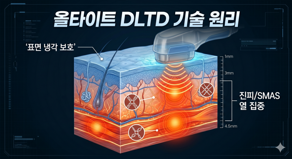 올타이트 주기 효과를 결정하는 DLTD 기술의 진피 및 SMAS층 고주파 전달 원리
