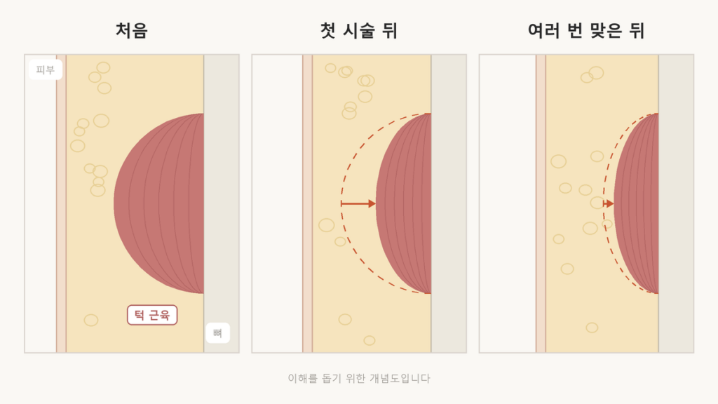 처음 보톡스를 맞았을 때와 여러 번 맞은 뒤 턱 근육이 줄어드는 폭을 비교한 근육 단면 개념도