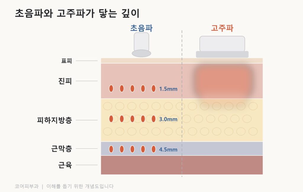 쿨소닉 유지기간, 몇 개월인지보다 먼저 정할 것 초음파가 근막층까지 열 응고점을 만들고 고주파가 진피층을 데우는 깊이를 비교한 피부 단면도
