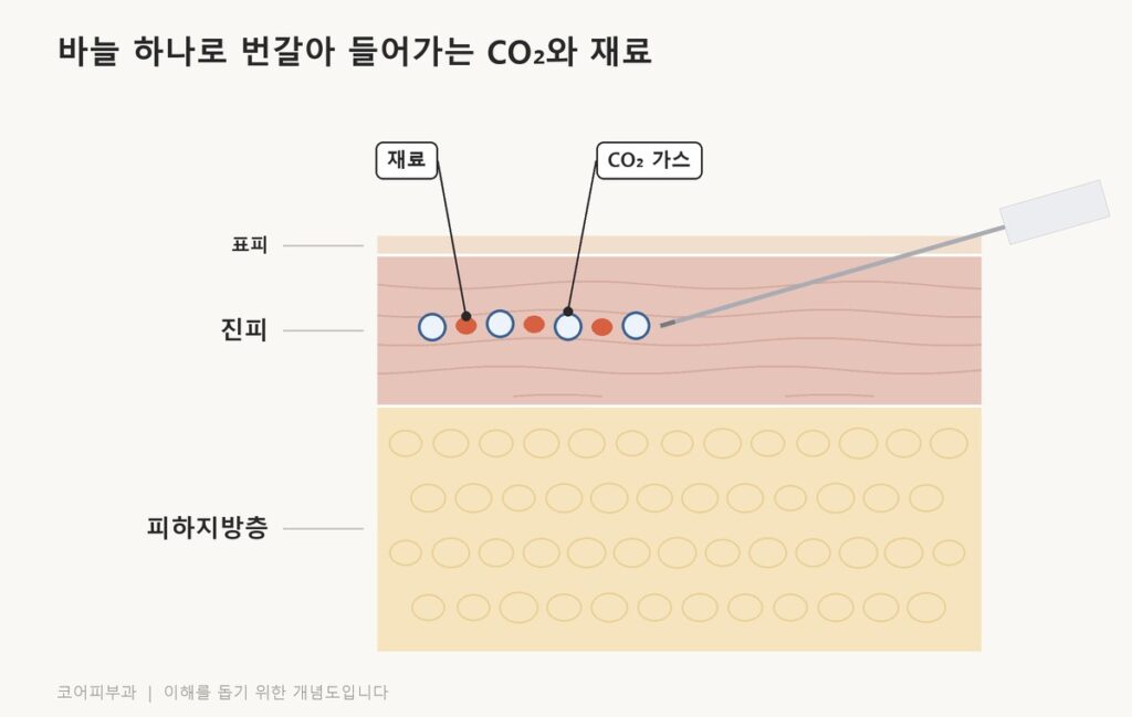 바늘 하나로 진피층에 CO₂ 가스와 재료가 번갈아 들어가는 모습을 그린 피부 단면도