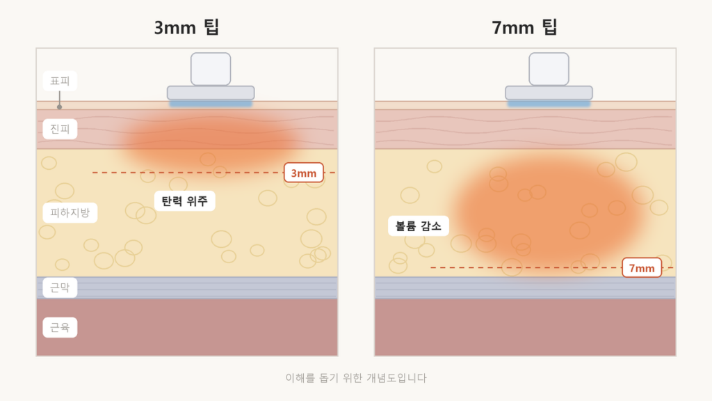 온다리프팅 가격, 8만 줄이 같은 8만 줄이 아닙니다 온다리프팅 3mm 팁은 피부 겉쪽에, 7mm 팁은 지방층과 근막층까지 열이 닿는 깊이 차이를 나타낸 피부 단면 개념도