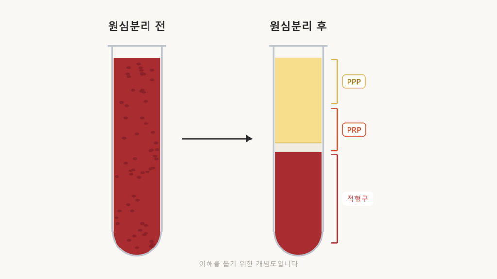 줄기세포주사 가격, 같은 이름이어도 들어가는 게 다릅니다 혈액을 원심분리하면 아래 적혈구, 가운데 혈소판이 모인 층, 위 혈장으로 나뉘는 모습과 PRP·PPP 위치를 나타낸 개념도