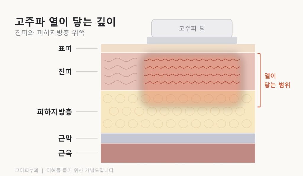 신사 써마지, 시술 당일 눈앞에서 확인할 4가지 고주파 열이 진피와 피하지방층 위쪽까지 전달되는 범위를 나타낸 피부 단면도