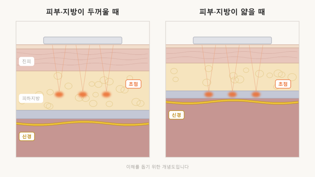 피부와 지방층이 두꺼운 얼굴과 얇은 얼굴에서 울쎄라 초점과 신경 사이의 거리가 달라지는 것을 비교한 피부 단면 개념도