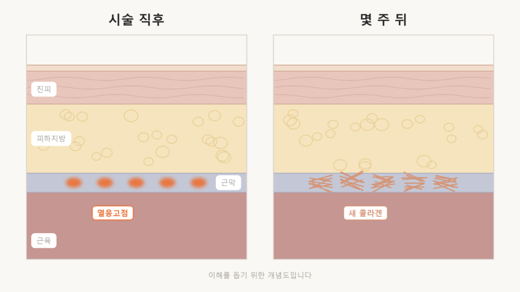 울쎄라 시술 직후 근막층에 열응고점이 생기고, 몇 주 뒤 그 자리에 새 콜라겐이 차오르는 두 단계를 비교한 피부 단면 개념도