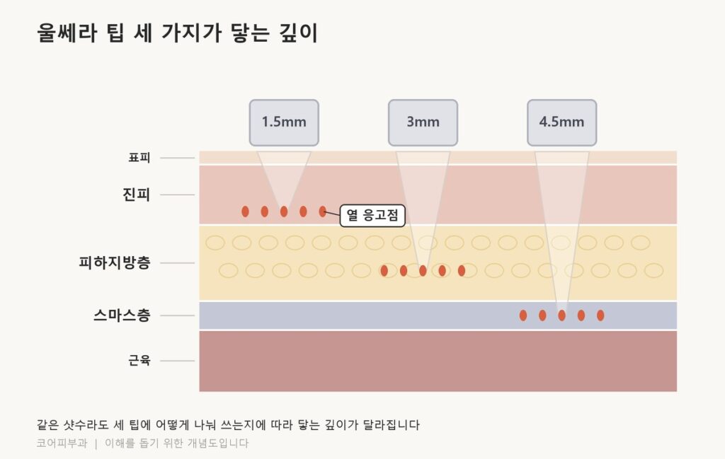 울쎄라 600샷 가격, 샷수는 얼굴이 정합니다 울쎄라의 1.5mm, 3mm, 4.5mm 팁이 각각 닿는 피부 깊이와 스마스층을 표시한 단면도