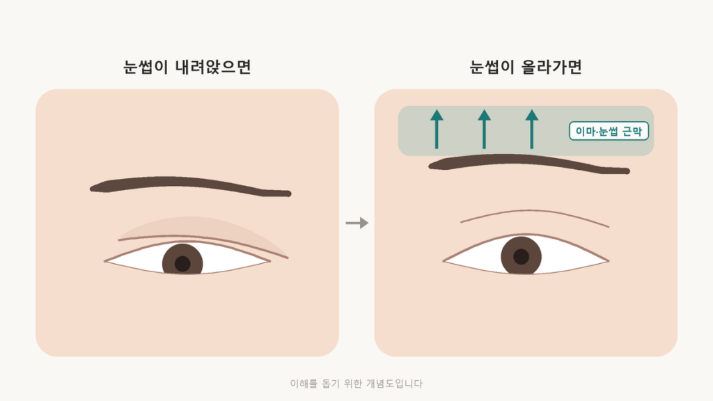 눈썹이 내려앉아 윗눈꺼풀이 쌍꺼풀 라인을 덮은 눈과, 이마·눈썹 쪽 근막이 당겨져 눈썹과 윗눈꺼풀이 함께 올라간 눈을 나란히 비교한 개념도