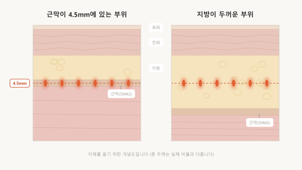 같은 4.5mm 초점이 피부가 얇은 부위에서는 근막에, 지방이 두꺼운 부위에서는 지방층에 맺히는 차이를 나타낸 피부 단면 개념도
